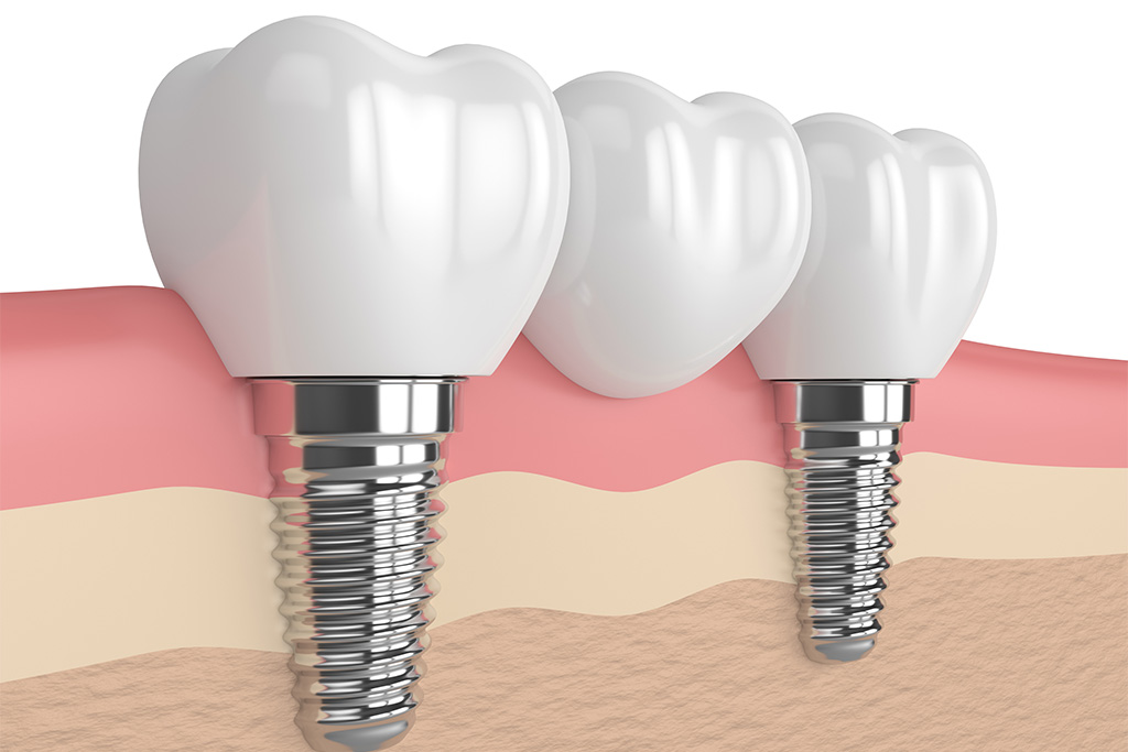 自分の歯のように、しっかり噛める歯に